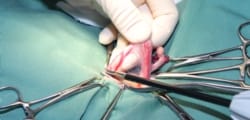 シーリングシステムを使用した手術